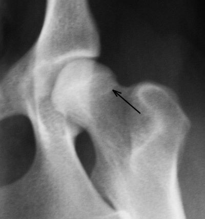 Hip_Femoral head_MorganLine