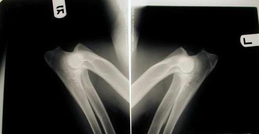 Normal Elbow xrays... ED Normal, rated by V in Germany